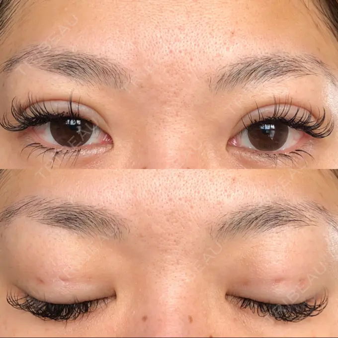 二重埋没 湘南美容クリニック 京都院 DAY 27 メイン用