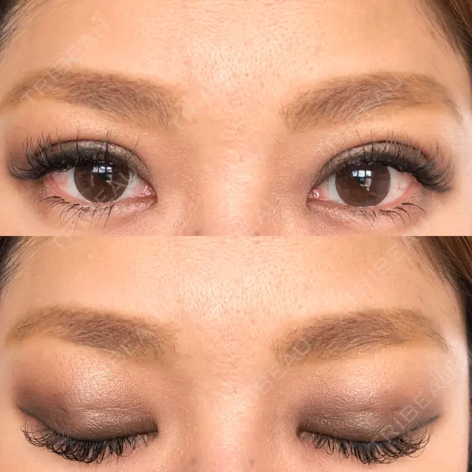 二重埋没 湘南美容クリニック 京都院 DAY 27 メイン用