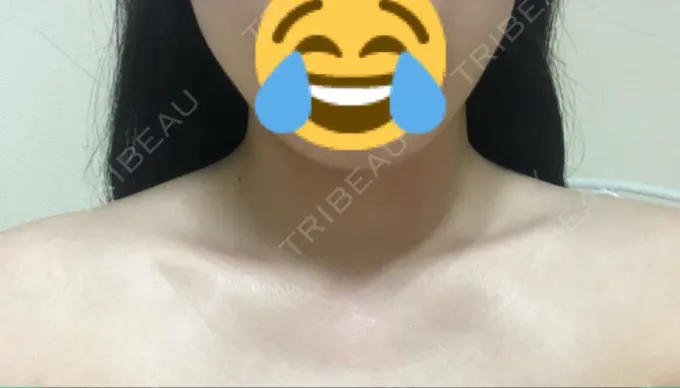 ボトックス（肩） 洗足整形・形成外科 DAY 4 メイン用