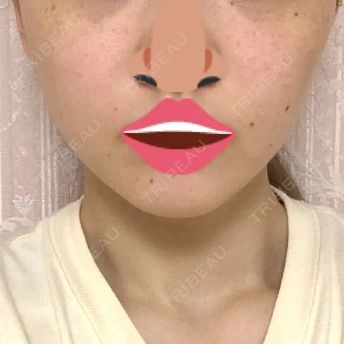 ボトックス（エラ・小顔） 品川スキンクリニック心斎橋院 AFTER メイン用