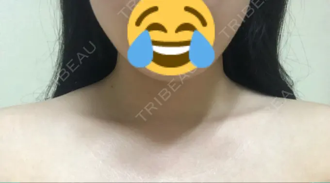 ボトックス（肩） 洗足整形・形成外科 DAY 5 メイン用