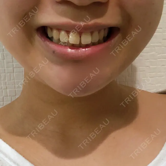 あごプロテーゼ 北尾クリニック AFTER メイン用