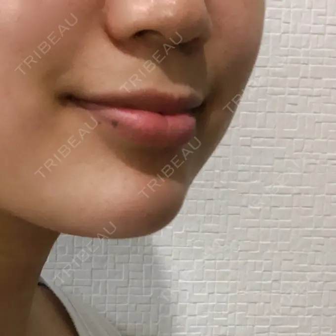 あごプロテーゼ 北尾クリニック DAY 583 メイン用