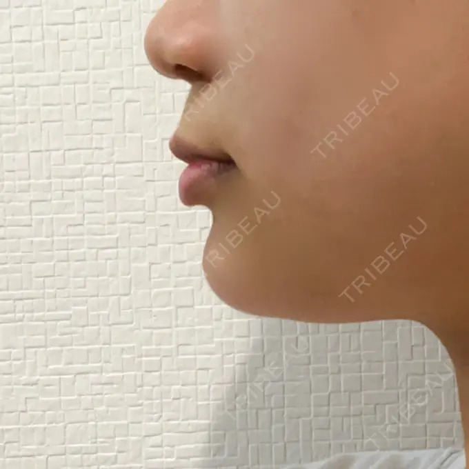 あごプロテーゼ 北尾クリニック DAY 583 メイン用