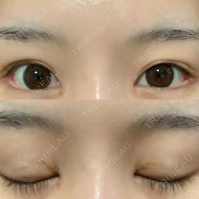 目頭切開 / 目尻切開 新宿ラクル美容外科クリニック 新宿院 DAY 34 メイン用