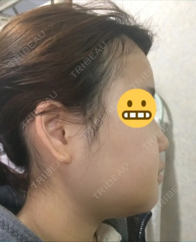 骨切り（あご） / その他（輪郭） マックスファクス銀座クリニック DAY 4 メイン用