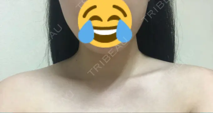 ボトックス（肩） 洗足整形・形成外科 DAY 6 メイン用