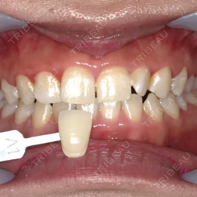 ホワイトニング 東京美容外科 赤坂院 AFTER メイン用