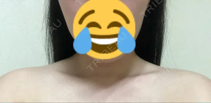 ボトックス（肩） 洗足整形・形成外科 DAY 7 メイン用