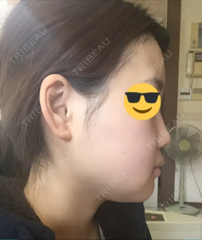 骨切り（あご） / その他（輪郭） マックスファクス銀座クリニック DAY 14 メイン用