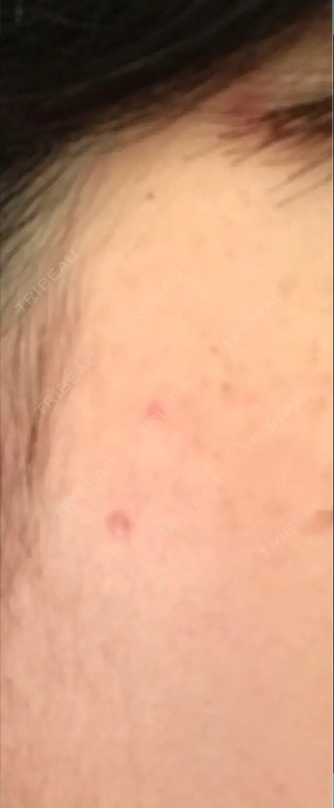 ほくろ・いぼ切除（肌） シンシアガーデンクリニック 太田院 DAY 33 メイン用