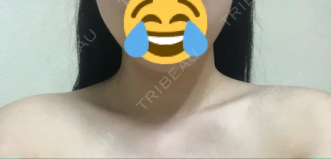 ボトックス（肩） 洗足整形・形成外科 DAY 8 メイン用