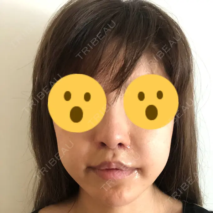 人中短縮 / 口角挙上 清潭女神美容外科 DAY 34 メイン用