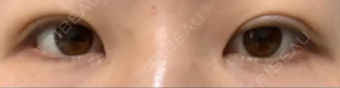 二重埋没 湘南美容クリニック 京都院 DAY 2 メイン用