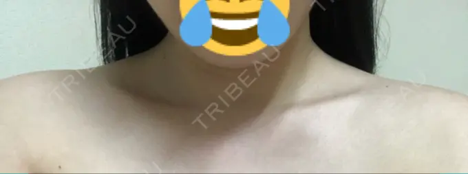 ボトックス（肩） 洗足整形・形成外科 DAY 9 メイン用