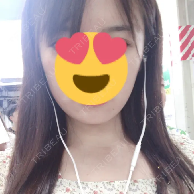 ボトックス（エラ・小顔） ルラ美容クリニック 高田馬場院 AFTER メイン用