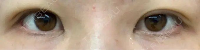 二重埋没 湘南美容クリニック 京都院 DAY 3 メイン用