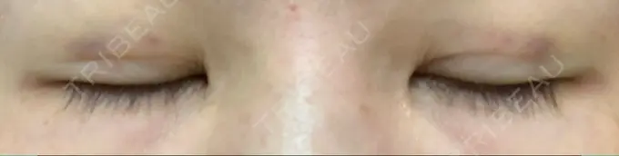 二重埋没 湘南美容クリニック 京都院 DAY 3 メイン用