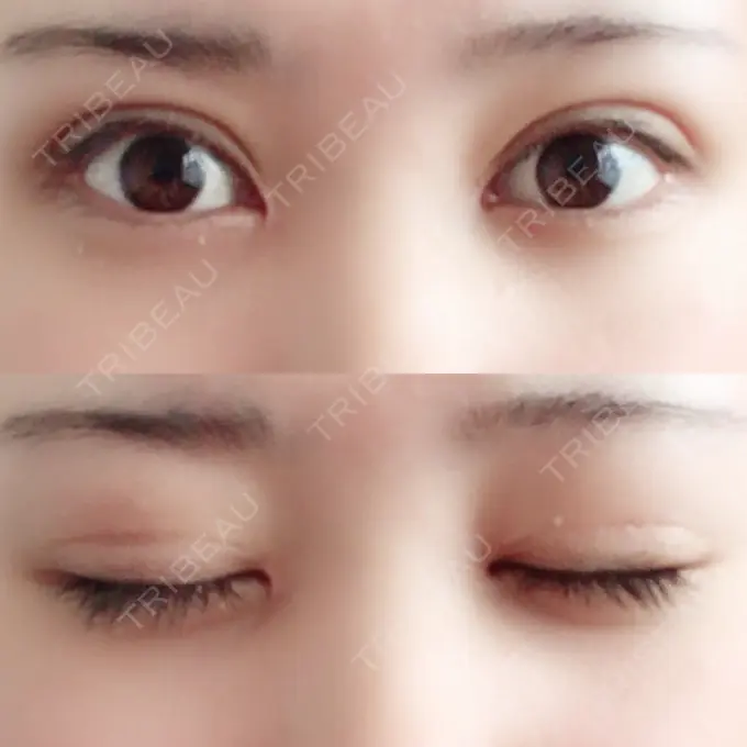 二重切開 / 目頭切開 城本クリニック 豊橋院 DAY 88 メイン用