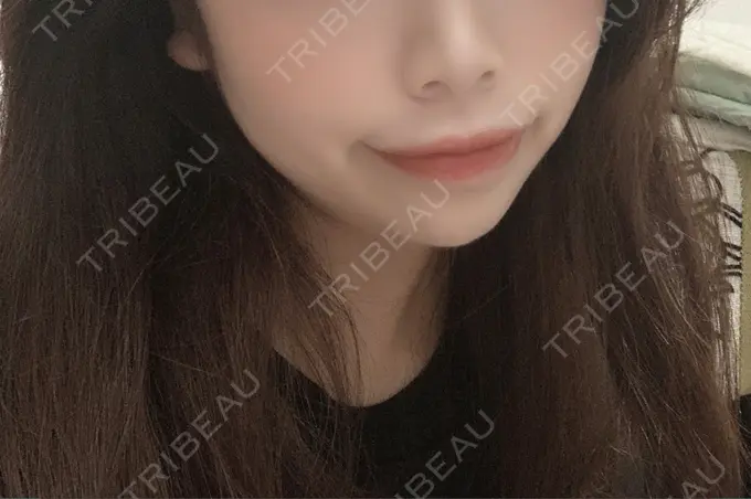 ヒアルロン酸注入（唇） ルラ美容クリニック 高田馬場院 DAY 1 メイン用