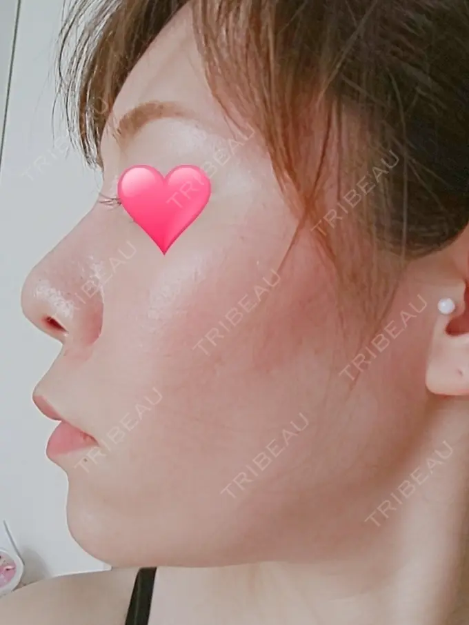 隆鼻術 品川スキンクリニック岡山院 AFTER メイン用