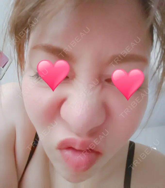 隆鼻術 品川スキンクリニック岡山院 DAY 82 メイン用