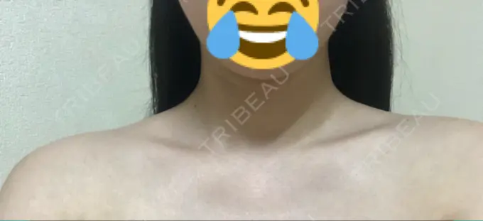 ボトックス（肩） 洗足整形・形成外科 AFTER メイン用