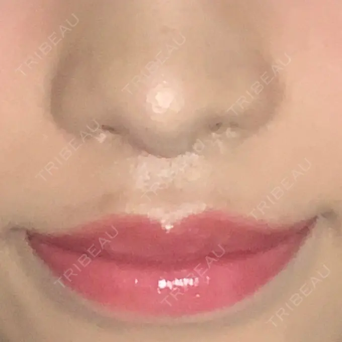 人中短縮 新宿ラクル美容外科クリニック 新宿院 DAY 39 メイン用