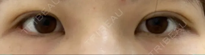 二重埋没 湘南美容クリニック 京都院 DAY 4 メイン用