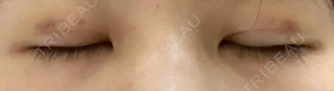 二重埋没 湘南美容クリニック 京都院 DAY 4 メイン用