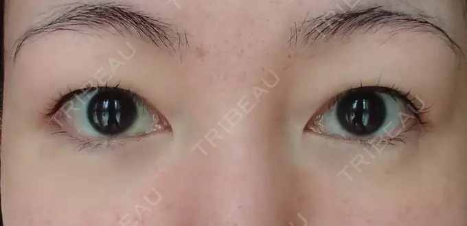 クマ治療 / 下まぶたたるみ取り / 下まぶたの脂肪取り / 脂肪注入（肌） コスメディカルクリニック シンシア 銀座院 DAY 33 メイン用