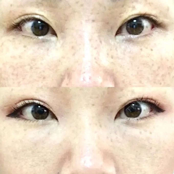 下まぶたたるみ取り / 下まぶたの脂肪取り 韓国ST美容整形外科 DAY 75 メイン用