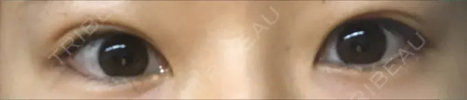 二重埋没 城本クリニック 福岡院 DAY 78 メイン用