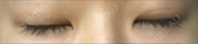 二重埋没 城本クリニック 福岡院 DAY 78 メイン用