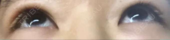 二重埋没 城本クリニック 福岡院 DAY 78 メイン用