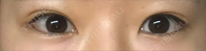 二重埋没 城本クリニック 福岡院 DAY 80 メイン用