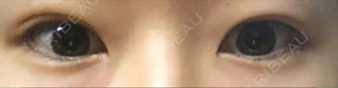 二重埋没 城本クリニック 福岡院 AFTER メイン用