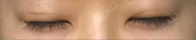 二重埋没 城本クリニック 福岡院 DAY 82 メイン用