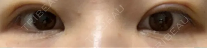 二重埋没 湘南美容クリニック 京都院 DAY 5 メイン用