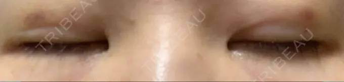 二重埋没 湘南美容クリニック 京都院 DAY 5 メイン用