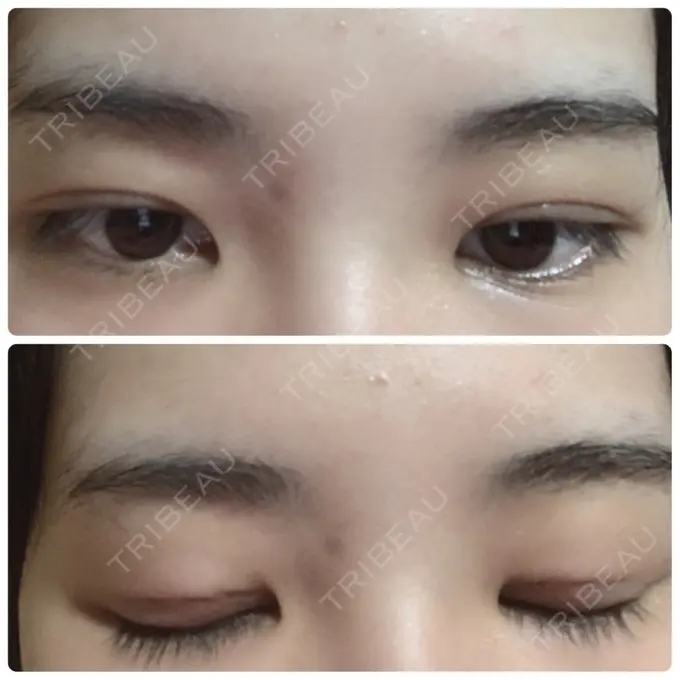 二重埋没 金沢中央クリニック DAY 6 メイン用