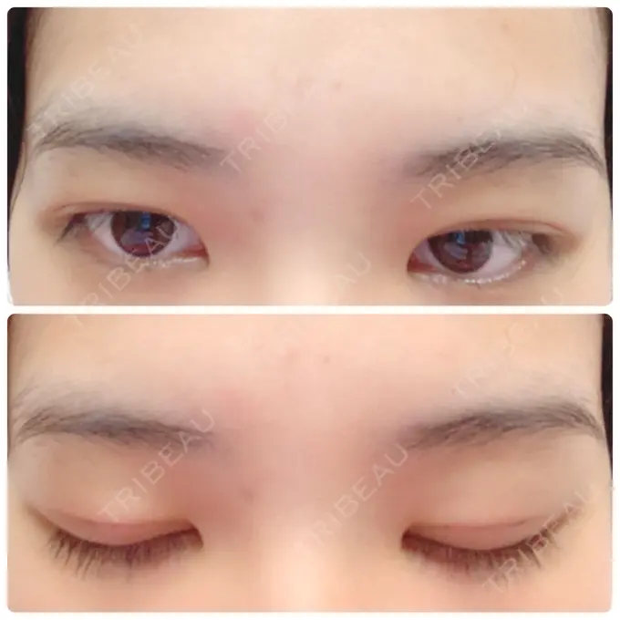 二重埋没 金沢中央クリニック DAY 10 メイン用