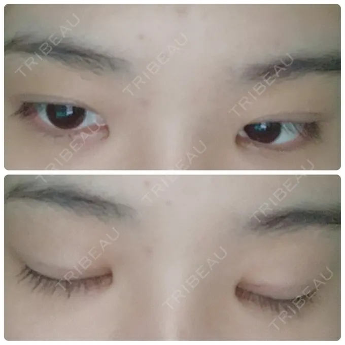 二重埋没 金沢中央クリニック DAY 9 メイン用