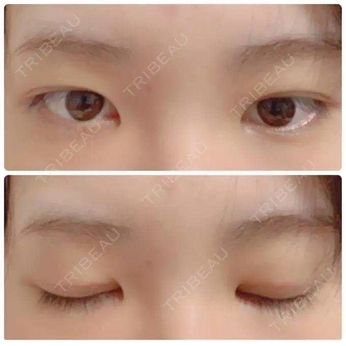 二重埋没 金沢中央クリニック DAY 35 メイン用