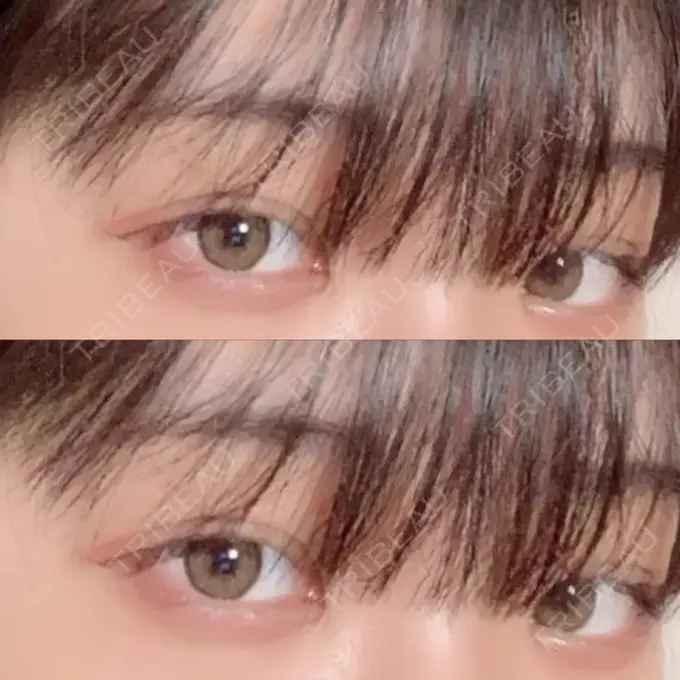 二重埋没 金沢中央クリニック AFTER メイン用