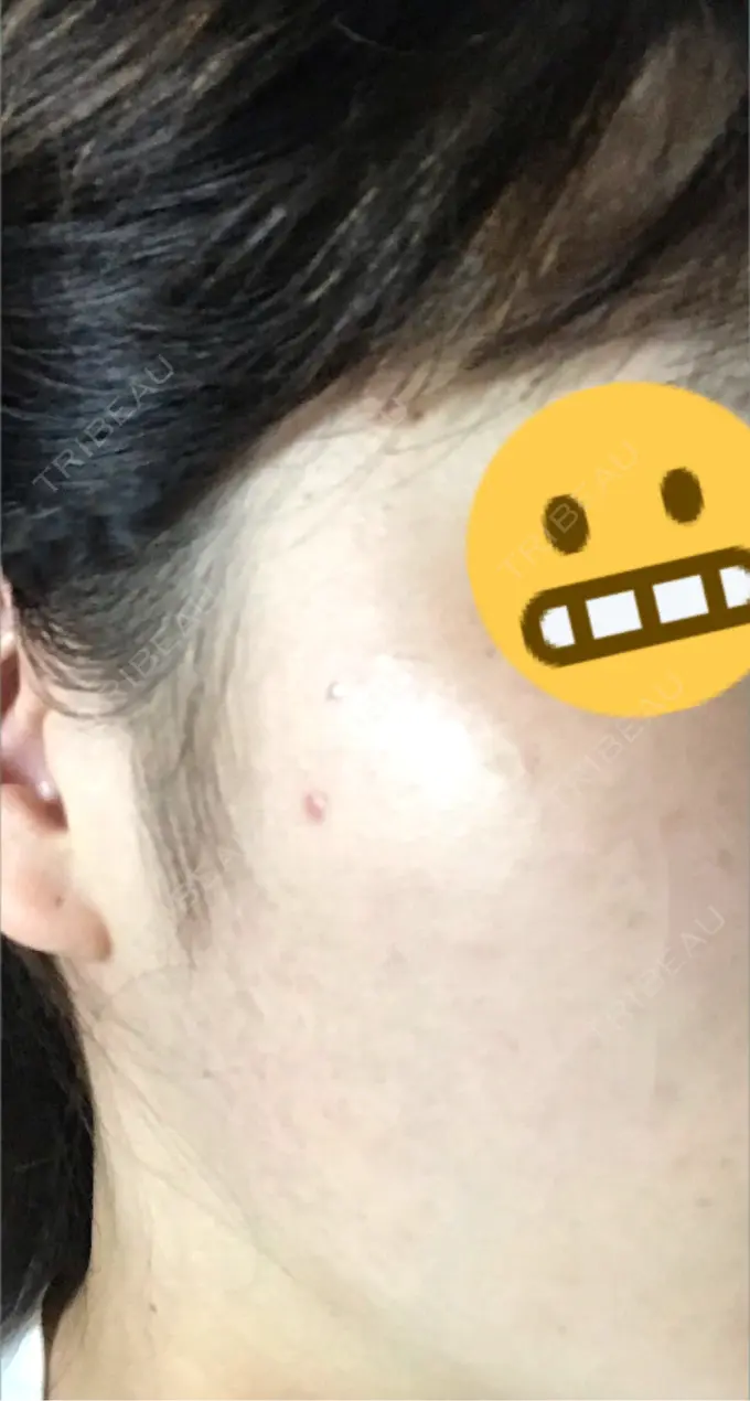 ほくろ・いぼ切除（肌） シンシアガーデンクリニック 太田院 DAY 38 メイン用