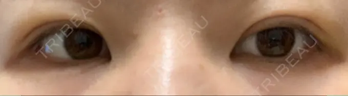 二重埋没 湘南美容クリニック 京都院 AFTER メイン用