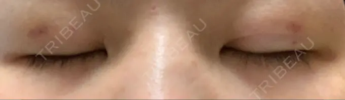 二重埋没 湘南美容クリニック 京都院 DAY 6 メイン用