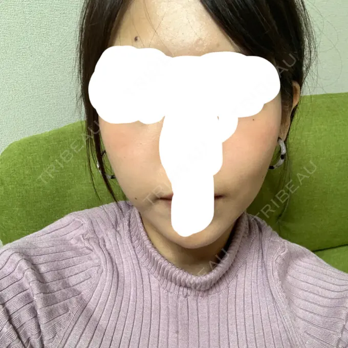 バッカルファット除去 / 脂肪吸引（顔） / ハイフ（顔） THE PLAN（ザ・プラン）美容整形外科・皮膚科 DAY 53 メイン用