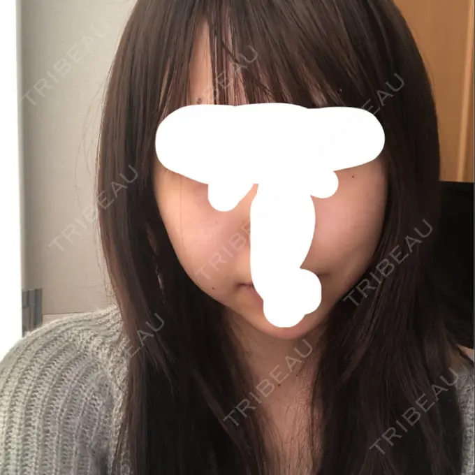 バッカルファット除去 / 脂肪吸引（顔） / ハイフ（顔） THE PLAN（ザ・プラン）美容整形外科・皮膚科 DAY 53 メイン用